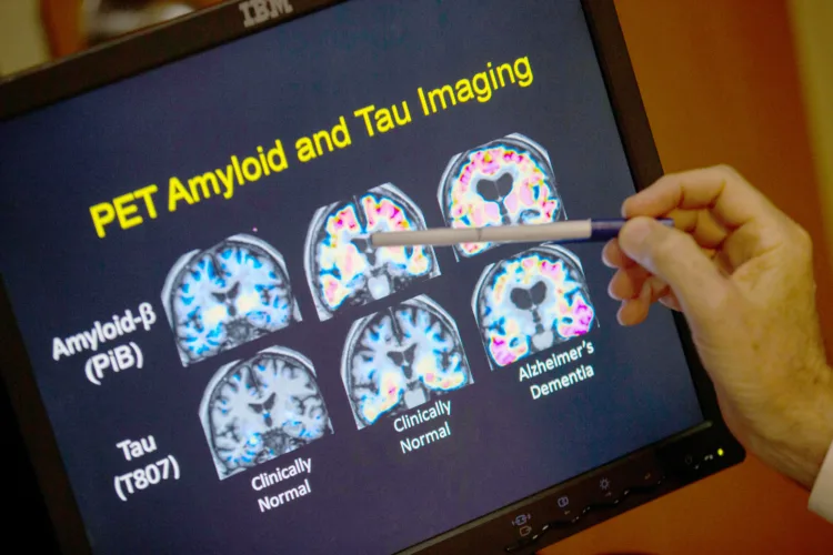 Dementia blood test isn’t totally necessary